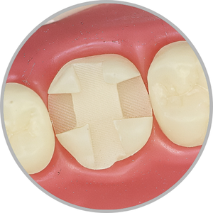 Dente 26 - Classe II (MODVP) (cod:26.J)
