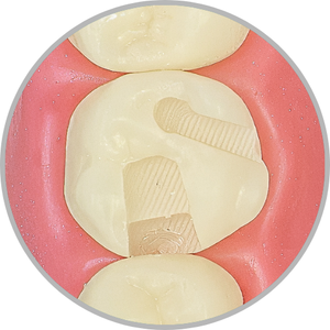 Dente 26 - Classe II MOP (com ponte de esmalte preservada) (cod:26.L)
