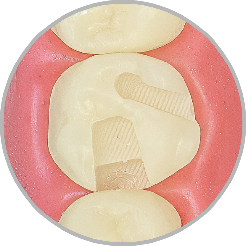 Dente 26 - Classe II MOP (com ponte de esmalte preservada) (cod:26.L)