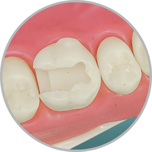 Dente 26 - Classe II (OD) (cod:26.M)