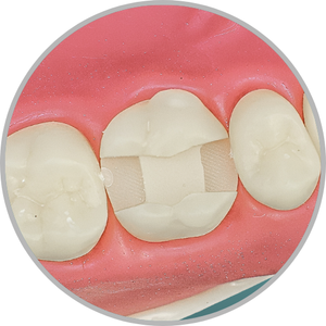 Dente 26 - Classe II (MOD) (cod:26.O)