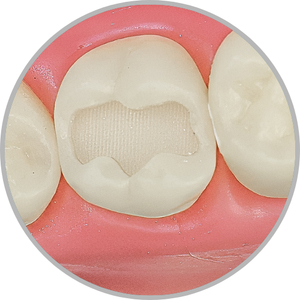 Dente 27 - Classe I (O) e Classe V (V e P) (cod:27.B)