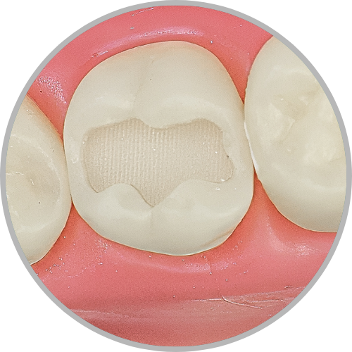 Dente 27 - Classe I (O) e Classe V (V e P) (cod:27.B)