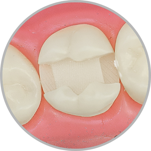 Dente 27 - Classe II (MOD) (cod:27.C)