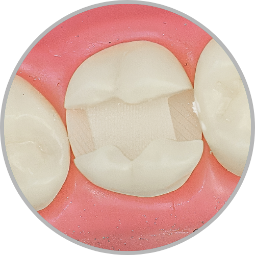 Dente 27 - Classe II (MOD) (cod:27.C)