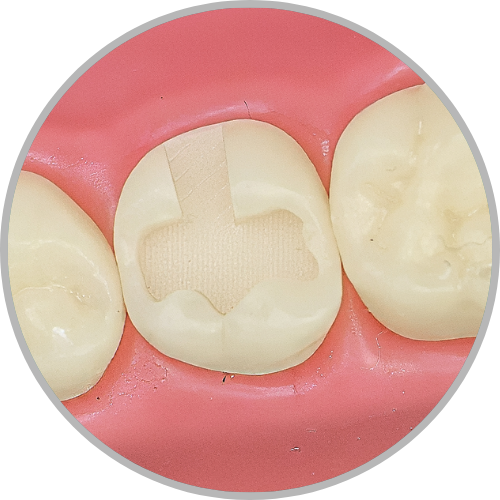 Dente 27 - Classe I (OP) (cod:27.D)