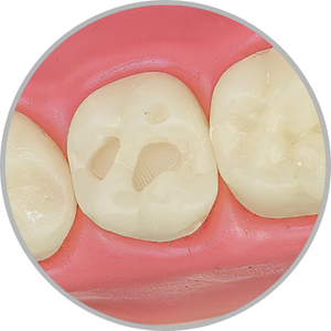 Dente 27 - Classe I (O) 3 pontos sendo 1 ponta de cúspide (cod:27.F)
