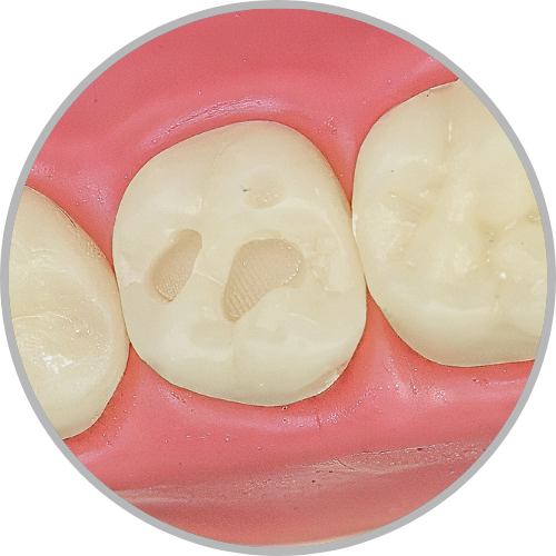 Dente 27 - Classe I (O) 3 pontos sendo 1 ponta de cúspide (cod:27.F)