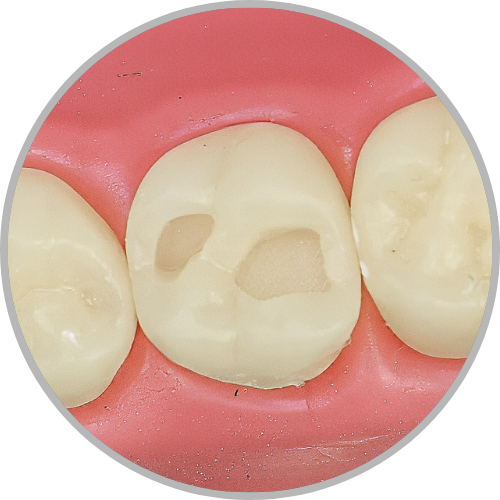 Dente 27 - Classe I (O) com preservação de ponte de esmalte (cod:27.G)