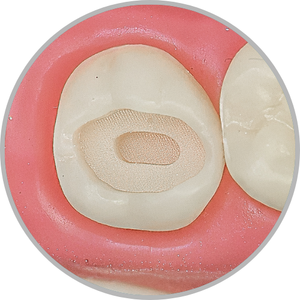 Dente 28 - Classe I (O) extensa em duas profundidades (cod:28.B)