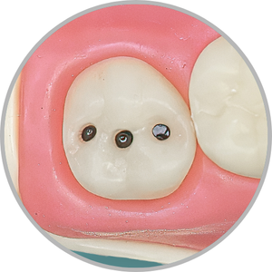 Dente 28 - Lesão de cárie classe I (O) 3 pontos (cod:28.C)