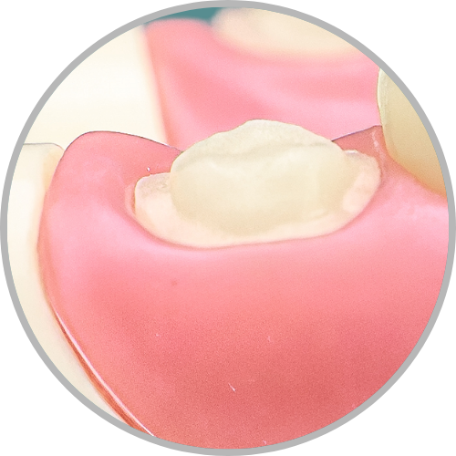 Dente 28 - Coroa Total (cod:28.D)