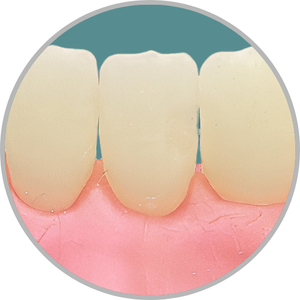 Dente 31 - Classe III (DV) (cod:31.A)