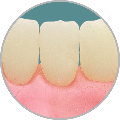 Dente 31 - Classe III (DV) (cod:31.A)