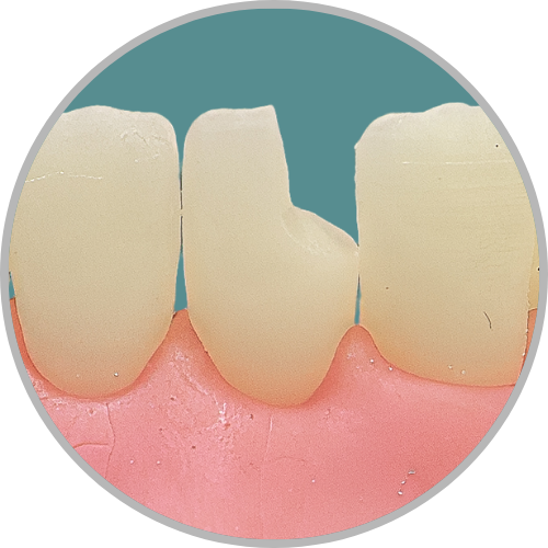 Dente 31 - Classe IV (D) (cod:31.B)