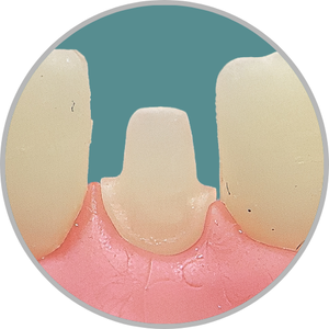 Dente 31 - Coroa Total (cod:31.D)