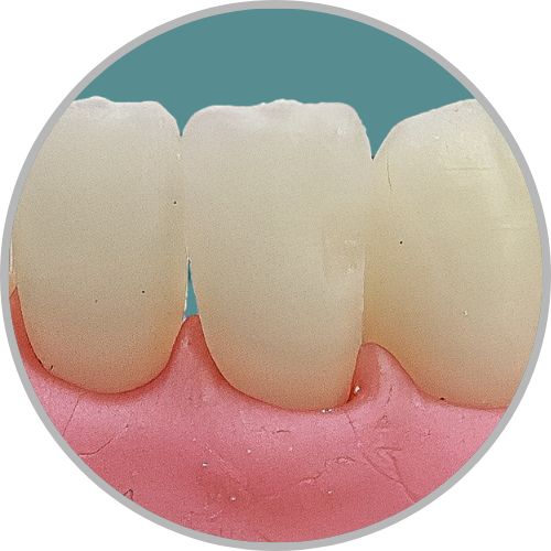 Dente 32 - Classe III (D) (cod:32.A)