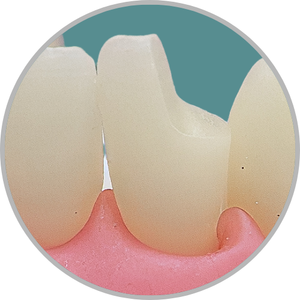 Dente 32 - Classe IV (D) (cod:32.B)