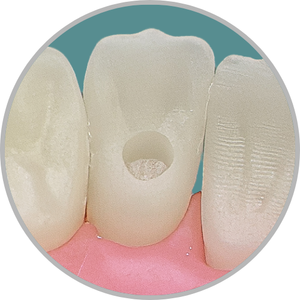 Dente 32 - Classe I (P) (cod:32.C)