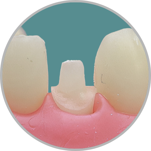 Dente 32 - Coroa Total (cod:32.D)