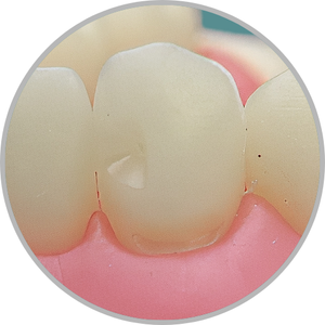 Dente 33 - Classe III (M) e Classe V (V) (cod:33.A)