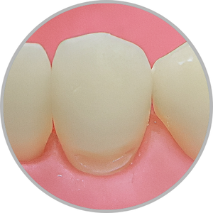 Dente 33 - Classe V (V) (cod:33.B)