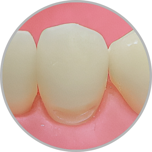 Dente 33 - Classe V (V) (cod:33.B)