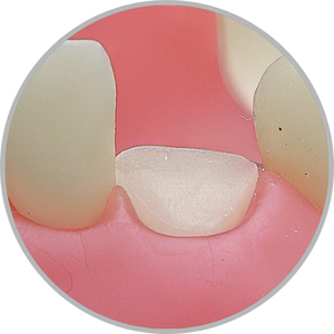 Dente 33 - Coto dental a nível de gengiva (cod:33.C)