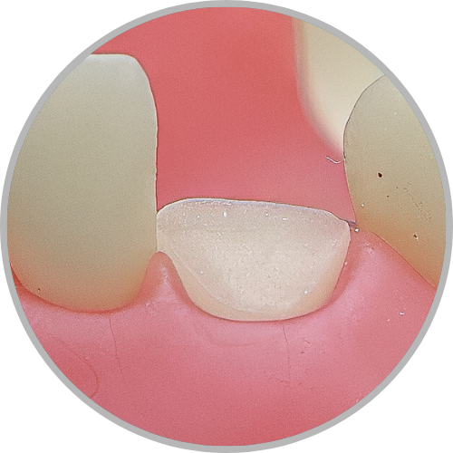 Dente 33 - Coto dental a nível de gengiva (cod:33.C)