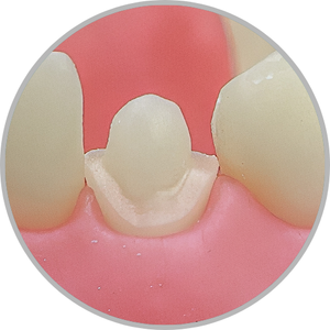 Dente 33 - Coroa Total (cod:33.D)
