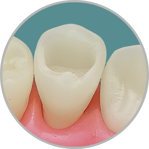 Dente 34 - Classe I (O) (cod:34.A)