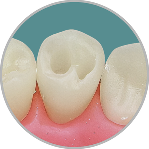 Dente 34 - Classe I (O) em 2 pontos (cod:34.B)