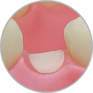 Dente 34 - Coto dental a nível de gengiva (cod:34.D)