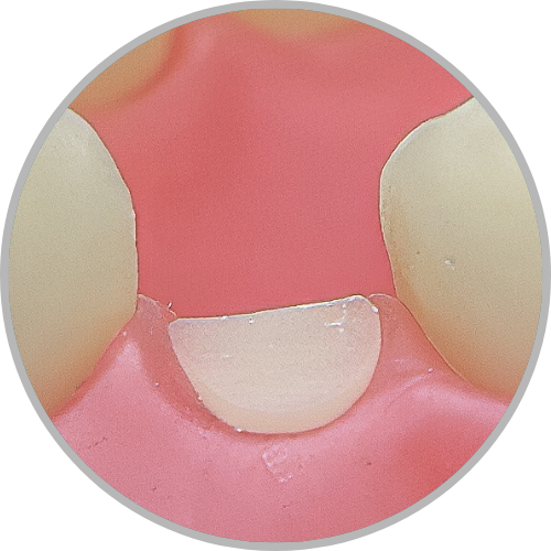 Dente 34 - Coto dental a nível de gengiva (cod:34.D)