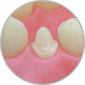 Dente 34 - Coroa Total (cod:34.E)