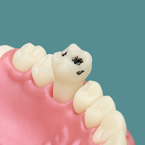 Dente Orais cariado