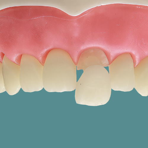 Dente Orais com coroa protética e faceta para cimentação