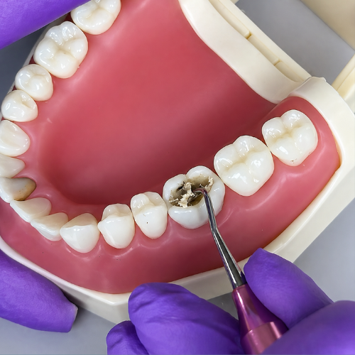 Dente Orais para remoção seletiva de cárie
