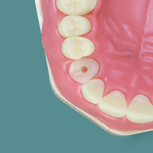 Dente Orais para retratamento endodôntico