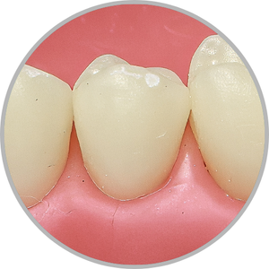 Dente 35 - Hígido (cod:35.0)