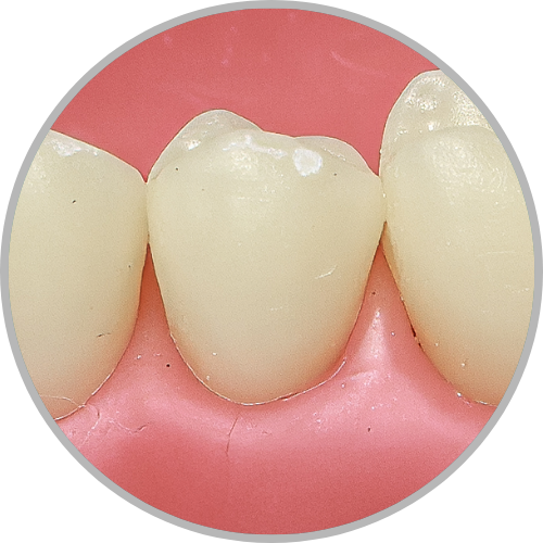Dente 35 - Hígido (cod:35.0)