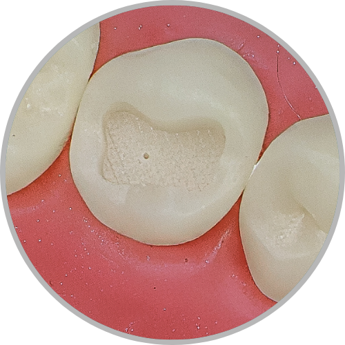 Dente 35 - Classe I (O) extensa (cod:35.A)
