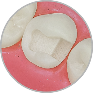 Dente 35 - Classe II (MO) (cod:35.B)