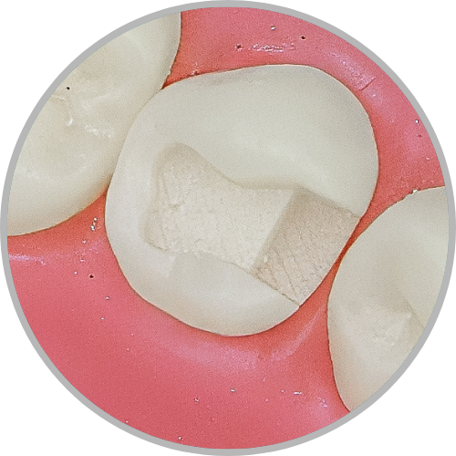 Dente 35 - Classe II (MO) (cod:35.B)