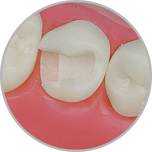 Dente 35 - Classe II (OD) (cod:35.C)