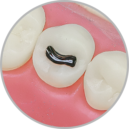 Dente 35 - Lesão de cárie classe I (O) (cod:35.D)