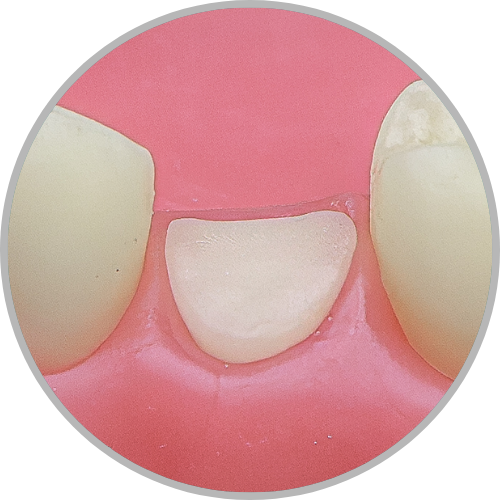 Dente 35 - Coto dental a nível de gengiva (cod:35.F)