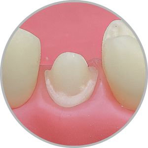 Dente 35 - Coroa Total (cod:35.G)