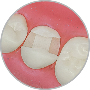 Dente 35 - Classe II (MOD) (cod:35.I)