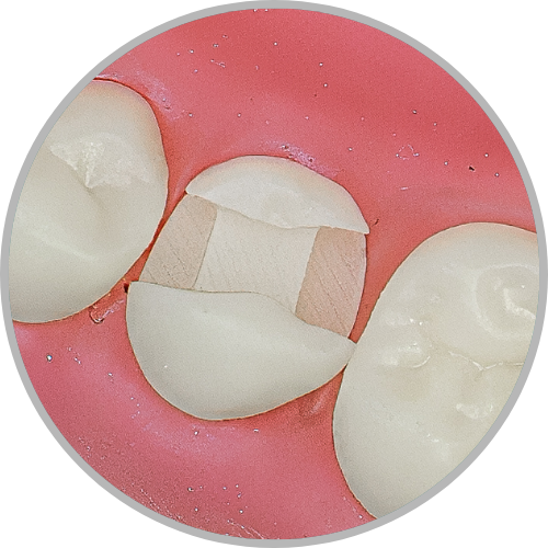 Dente 35 - Classe II (MOD) (cod:35.I)